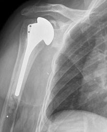 Which Has Better Results: Total Shoulder Arthroplasty or ...